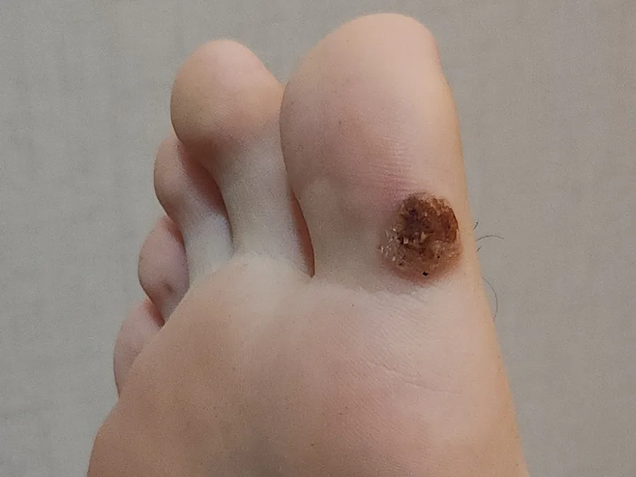 사마귀 치료 전