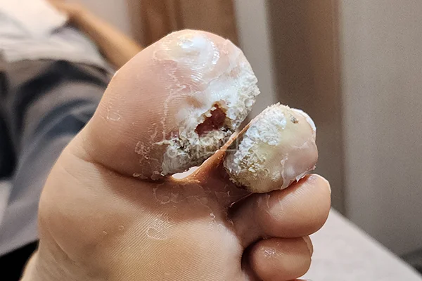 치료 전 발가락 사마귀