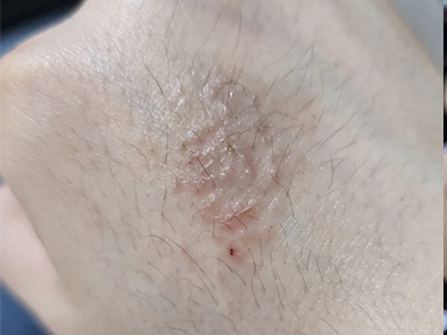 화폐상습진 치료 전