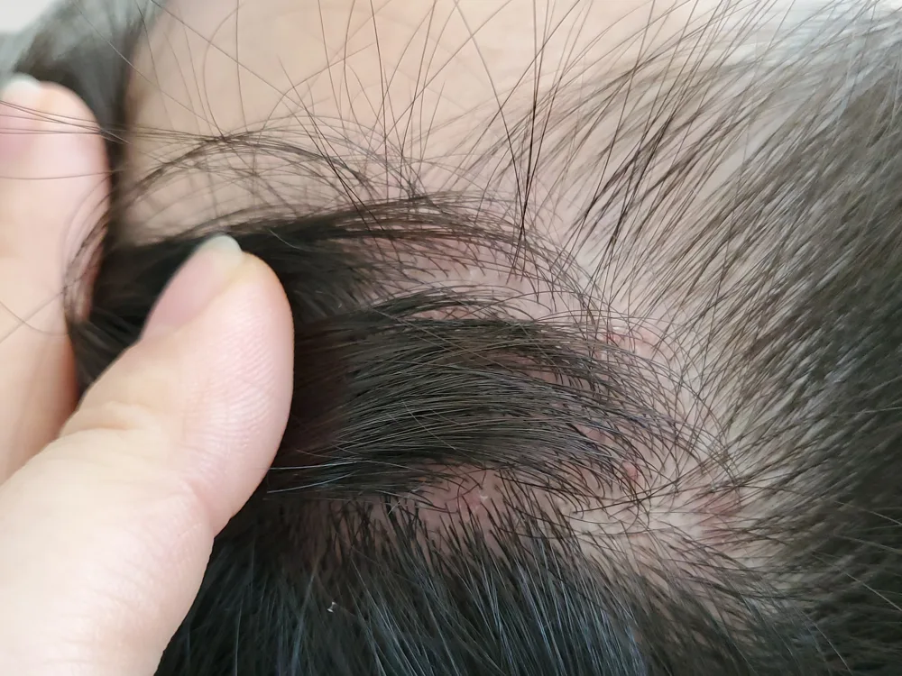 두피의 지루두피염 — 머리카락 사이 붉은 발적과 각질