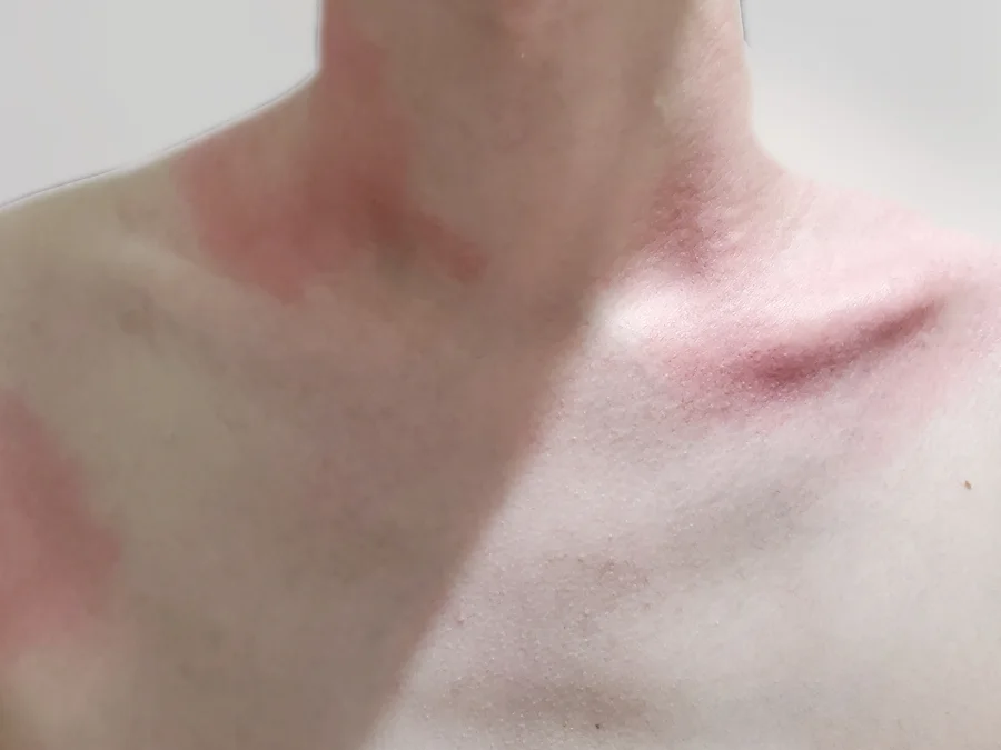 목과 쇄골의 두드러기 — 붉게 부어오른 팽진